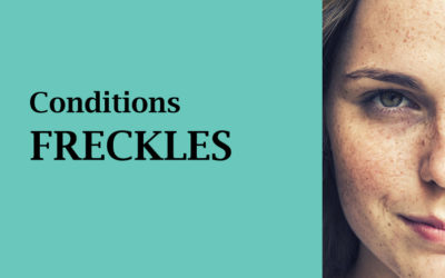 FRECKLES