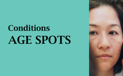 AGE SPOTS